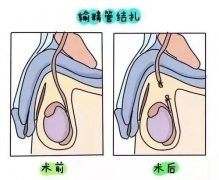 結(jié)扎了還可以做泰國試管嬰兒嗎？