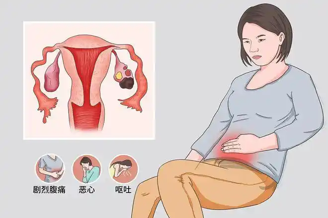 巧克力囊腫是什么原因引起的?做試管成功率高不高這里有答案