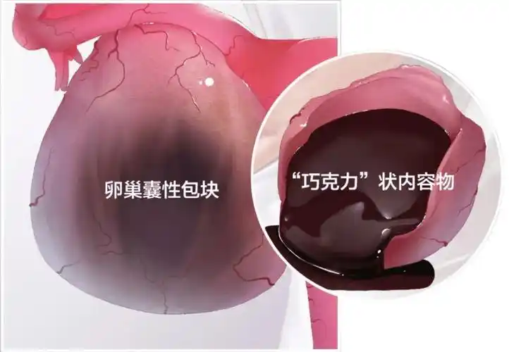 巧克力囊腫是什么原因引起的?做試管成功率高不高這里有答案