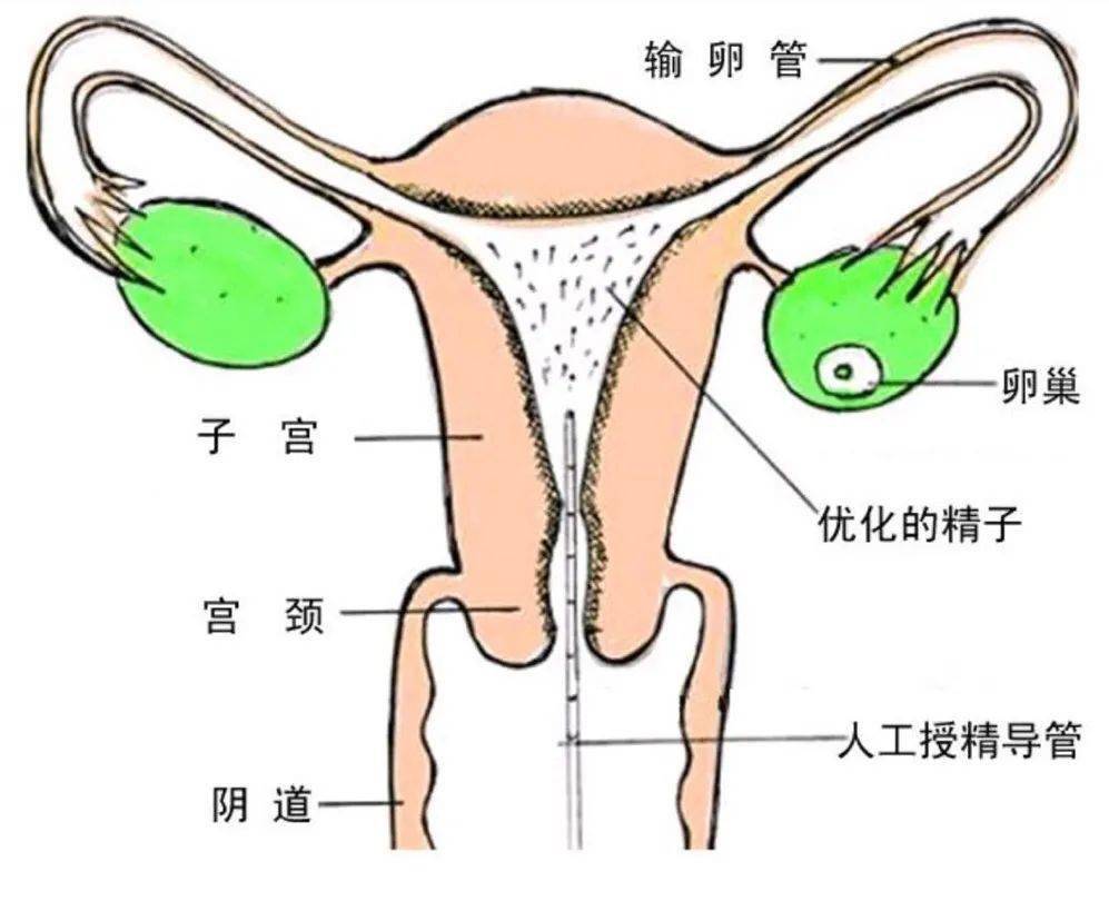 做人工受孕需要什么條件?附治療全流程介紹