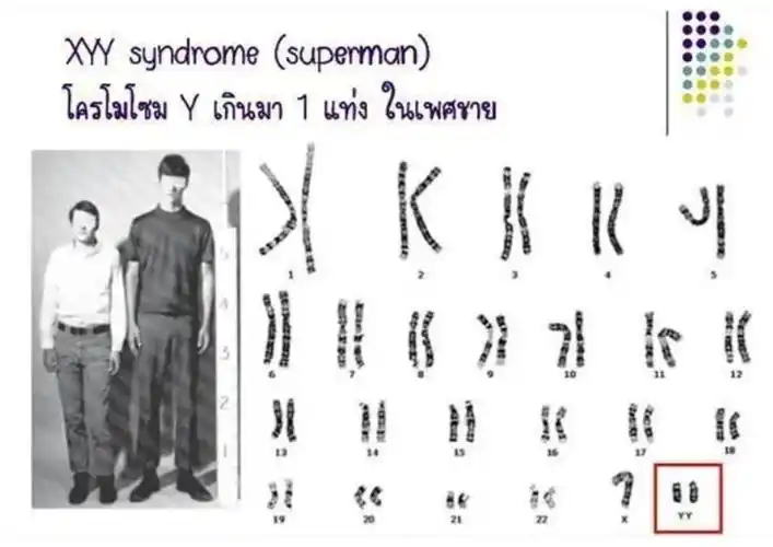 30秒帶你深度了解超雄綜合癥孩子的特點(diǎn)和表現(xiàn)