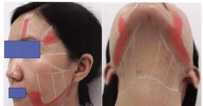 諾雷得功效及副作用